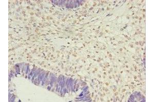Immunohistochemistry of paraffin-embedded human ovarian cancer using ABIN7163399 at dilution of 1:100 (PRTFDC1 Antikörper  (AA 2-225))