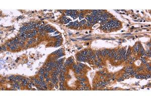 Immunohistochemistry of paraffin-embedded Human colon cancer tissue using KIR2DL1/3/4/S4 Polyclonal Antibody at dilution 1:30 (KIR2DL1/3/4/S4 Antikörper)