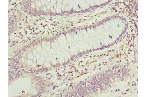 Immunohistochemistry of paraffin-embedded human colon cancer using ABIN7165174 at dilution of 1:100 (TNRC5 Antikörper  (AA 31-278))