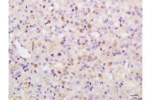 Formalin-fixed and paraffin embedded human brain glioma tissue labeled with Anti-Phospho-Wee1(Ser642) Polyclonal Antibody, Unconjugated  at 1:200 followed by conjugation to the secondary antibody and DAB staining (WEE1 Antikörper  (pSer642))