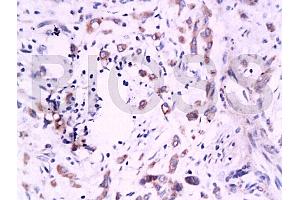Formalin-fixed and paraffin embedded human colon carcinoma labeled Anti-B7H4 Polyclonal Antibody, Unconjugated (ABIN671736) at 1:200, followed by conjugation to the secondary antibody and DAB staining (VTCN1 Antikörper  (AA 50-100))