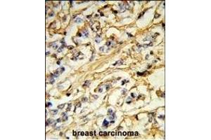 Formalin-fixed and paraffin-embedded human breast carcinoma reacted with CHB Antibody (N-term), which was peroxidase-conjugated to the secondary antibody, followed by DAB staining.