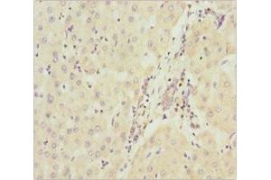 Immunohistochemistry of paraffin-embedded human liver cancer using ABIN7160913 at dilution of 1:100 (NDUFA9 Antikörper  (AA 1-270))