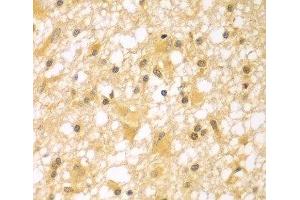 Immunohistochemistry of paraffin-embedded Human brain cancer using PAK6 Polyclonal Antibody at dilution of 1:100 (40x lens). (PAK6 Antikörper)