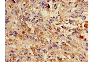 Immunohistochemistry of paraffin-embedded human melanoma using ABIN7157786 at dilution of 1:100 (DCT Antikörper  (AA 44-205))