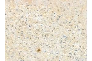 ABIN6258819 and ABIN6273540 at 1/100 staining human gastric carcinoma by IHC-P.