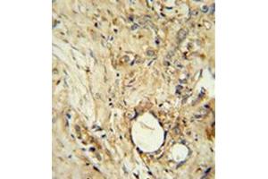 Immunohistochemistry analysis in formalin fixed and paraffin embedded human breast carcinoma reacted with AP52256PU-N, which was peroxidase conjugated to the secondary antibody and followed by DAB staining.