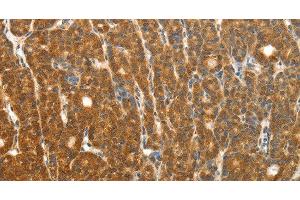 Immunohistochemistry of paraffin-embedded Human thyroid cancer using PTCH1 Polyclonal Antibody at dilution of 1:50 (Patched 1 Antikörper)