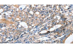 Immunohistochemistry of paraffin-embedded Human gastric cancer using AKR1D1 Polyclonal Antibody at dilution of 1:35 (AKR1D1 Antikörper)