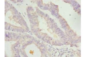 Immunohistochemistry of paraffin-embedded human endometrial cancer using ABIN7157970 at dilution of 1: 100 (LEFTY2 Antikörper  (AA 57-366))