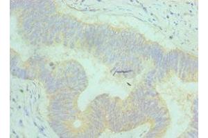 Immunohistochemistry of paraffin-embedded human colon cancer using ABIN7144372 at dilution of 1:100