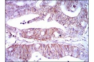 Immunohistochemical analysis of paraffin-embedded rectum cancer tissues using LPA mouse mAb with DAB staining. (Lp(a) Antikörper  (AA 1823-2013))