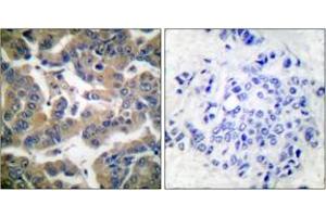 Immunohistochemistry analysis of paraffin-embedded human breast carcinoma, using GR (Phospho-Ser211) Antibody. (GR (AA 181-230), (pSer211) Antikörper)