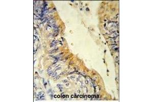 Formalin-fixed and paraffin-embedded human colon carcinoma reacted with ACADM Antibody (Center), which was peroxidase-conjugated to the secondary antibody, followed by DAB staining. (Medium-Chain Specific Acyl-CoA Dehydrogenase, Mitochondrial (MCAD) (AA 189-217) Antikörper)