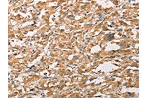 The image on the left is immunohistochemistry of paraffin-embedded Human thyroid cancer tissue using ABIN7131608(WNT11 Antibody) at dilution 1/20, on the right is treated with fusion protein. (WNT11 Antikörper)