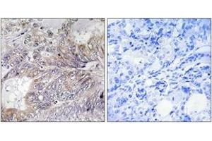 Immunohistochemistry analysis of paraffin-embedded human breast carcinoma tissue, using BAD (Ab-155) Antibody. (BAD Antikörper  (AA 119-168))