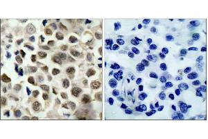 Immunohistochemical analysis of paraffin-embedded human lung carcinoma tissue, using HDAC8 (phospho-Ser39) antibody (E011128). (HDAC8 Antikörper  (pSer39))