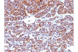 Formalin-fixed, paraffin-embedded human Melanoma stained with Moesin Mouse Monoclonal Antibody (MSN/492).