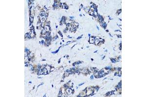 Immunohistochemistry of paraffin-embedded human breast cancer using HDAC5 antibody (ABIN6290464) at dilution of 1:100 (40x lens).