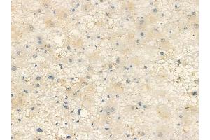 ABIN6257844 and ABIN6274385 at 1/100 staining human astrocytoma by IHC-P. (DOK7 Antikörper  (C-Term))
