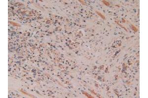 IHC-P analysis of Human Prostate Gland Cancer Tissue, with DAB staining. (Cytochrome C Antikörper  (AA 5-100))