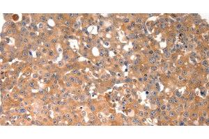 Immunohistochemistry of paraffin-embedded Human breast cancer tissue using BGLAP Polyclonal Antibody at dilution of 1:40 (Osteocalcin Antikörper)