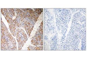 Immunohistochemistry analysis of paraffin-embedded human liver carcinoma tissue, using BAG3 antibody.