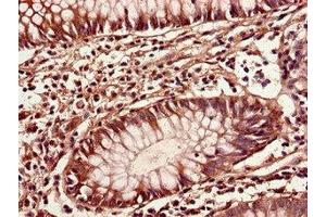 Immunohistochemistry of paraffin-embedded human colon cancer using ABIN7149396 at dilution of 1:100 (CIAO3 (AA 2-265) Antikörper)
