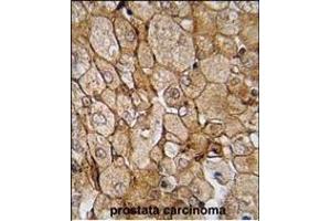 Formalin-fixed and paraffin-embedded human prostata carcinoma tissue reacted with CK1G (Center ) (ABIN391377 and ABIN2841388) , which was peroxidase-conjugated to the secondary antibody, followed by DAB staining. (CAMK1G Antikörper  (AA 211-241))