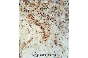 DCLRE1C Antibody (N-term) (ABIN653693 and ABIN2843013) immunohistochemistry analysis in formalin fixed and paraffin embedded human lung carcinoma followed by peroxidase conjugation of the secondary antibody and DAB staining. (DCLRE1C Antikörper  (N-Term))