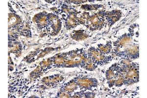 ABIN6257712 and ABIN6273523 at 1/100 staining human colorectal cancer by IHC-P.