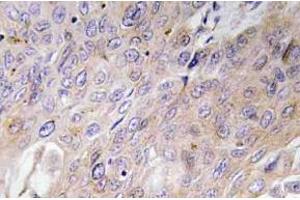 Immunohistochemistry (IHC) analyzes of BMP-3 antibody in paraffin-embedded human lung carcinoma tissue. (BMP3 Antikörper)