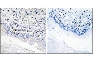 Immunohistochemistry analysis of paraffin-embedded human lung carcinoma, using MED12 Antibody. (MED12 Antikörper  (AA 611-660))
