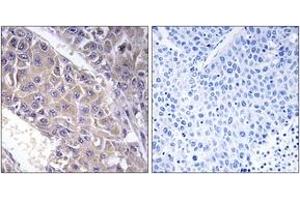 Immunohistochemistry analysis of paraffin-embedded human liver carcinoma tissue, using B4GALT3 Antibody. (B4GALT3 Antikörper  (AA 271-320))