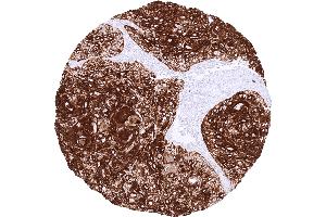 Squamous cell carcinoma of the skin with strong CK17 staining of all tumor cells