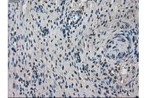 Immunohistochemical staining of paraffin-embedded Adenocarcinoma of breast tissue using anti-TMEM100 mouse monoclonal antibody. (TMEM100 Antikörper)