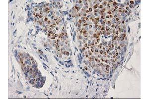 Immunohistochemical staining of paraffin-embedded Adenocarcinoma of Human breast tissue using anti-OSGEP mouse monoclonal antibody.