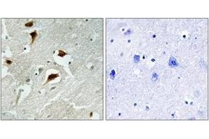 Immunohistochemistry analysis of paraffin-embedded human brain carcinoma, using 4E-BP1 (Phospho-Thr69) Antibody. (eIF4EBP1 Antikörper  (pThr69))
