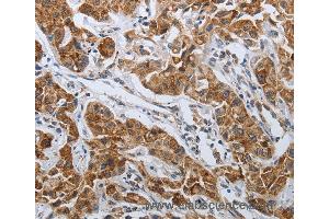 Immunohistochemistry of Human lung cancer using SPAG1 Polyclonal Antibody at dilution of 1:25 (SPAG1 Antikörper)
