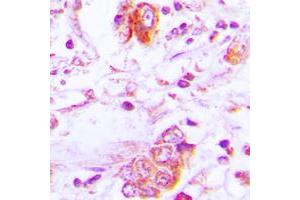 Immunohistochemical analysis of Follistatin staining in human lung cancer formalin fixed paraffin embedded tissue section. (Follistatin Antikörper  (Center))