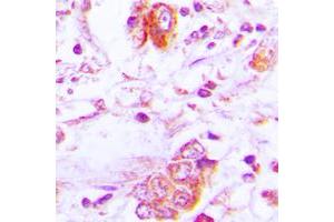 Immunohistochemical analysis of Follistatin staining in human lung cancer formalin fixed paraffin embedded tissue section.