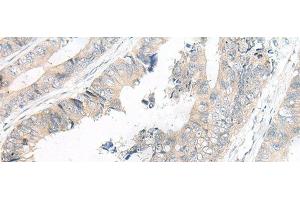 Immunohistochemistry of paraffin-embedded Human colorectal cancer tissue using FGF10 Polyclonal Antibody at dilution of 1:30(x200) (FGF10 Antikörper)