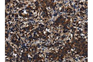 The image on the left is immunohistochemistry of paraffin-embedded Human liver cancer tissue using ABIN7191225(KLHL8 Antibody) at dilution 1/20, on the right is treated with synthetic peptide. (KLHL8 Antikörper)