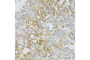 Immunohistochemistry of paraffin-embedded human prostate cancer using ND5 antibody (ABIN5975833) at dilution of 1/100 (40x lens).