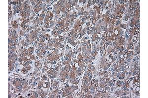 Immunohistochemical staining of paraffin-embedded Carcinoma of liver tissue using anti-TRPM4mouse monoclonal antibody. (TRPM4 Antikörper)