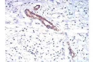 Immunohistochemical analysis of paraffin-embedded liver cancer tissues using TSHB mouse mAb with DAB staining.