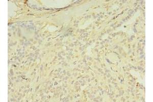 Immunohistochemistry of paraffin-embedded human breast cancer using ABIN7172654 at dilution of 1:100 (SPIC Antikörper  (AA 1-248))