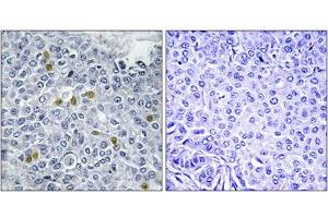 Immunohistochemical staining of paraffin-embedded human breast carcinoma tissue reacted with TOP2A (phospho S1106) polyclonal antibody  at 1:50-1:100 dilution. (Topoisomerase II alpha Antikörper  (pSer1106))