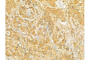 ABIN6265998 and ABIN6273087 at 1/100 staining Human breast cancer by IHC-P. (VPS37A Antikörper  (N-Term))