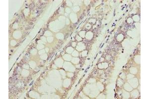 Immunohistochemistry of paraffin-embedded human colon cancer using ABIN7175315 at dilution of 1:100 (VPS45 Antikörper  (AA 101-400))
